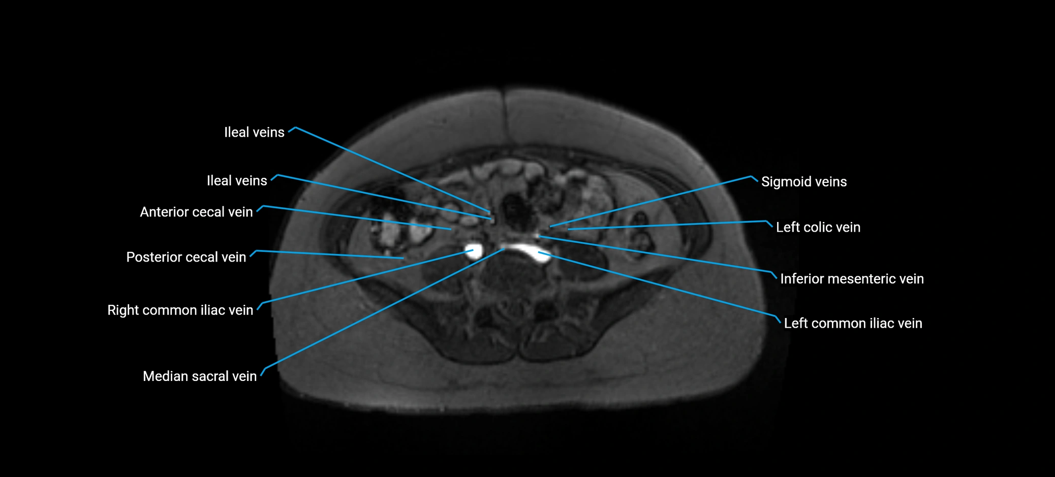 MRV abdomen pelvis & lower limb axial cross sectional anatomy labelled MRI image 124 (1).webp